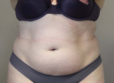 Liposuction Before & After Gallery - Patient 121378008 - Image 1