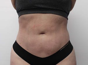 Before & After Liposuction in Phoenix - 01