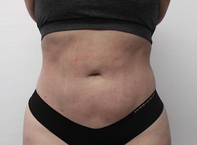 Liposuction Before & After Gallery - Patient 121378008 - Image 2