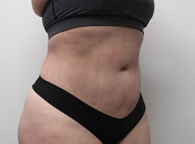 Liposuction Before & After Gallery - Patient 121378008 - Image 4