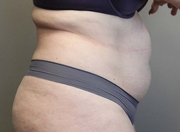 Liposuction Before & After Gallery - Patient 121378008 - Image 5