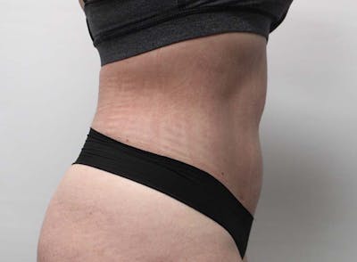 Liposuction Before & After Gallery - Patient 121378008 - Image 6