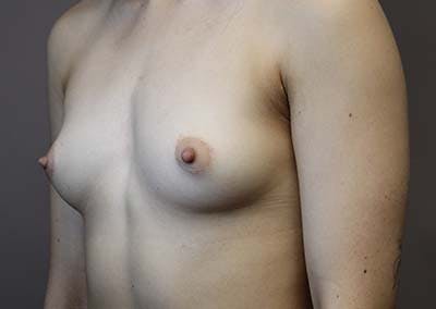 Breast Augmentation Before & After Gallery - Patient 122106620 - Image 1