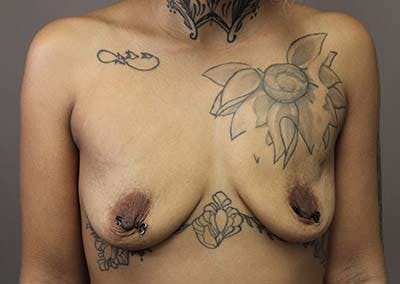 Breast Augmentation Before & After Gallery - Patient 122106785 - Image 1