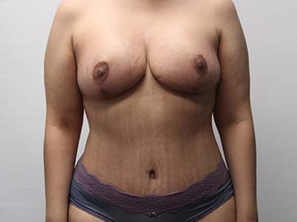Mommy Makeover Before & After Gallery - Patient 122106829 - Image 2