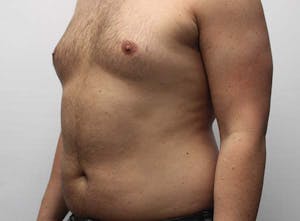 Before and After Male Liposuction in Phoenix