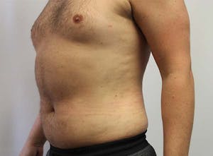 Before and After Male Liposuction in Phoenix