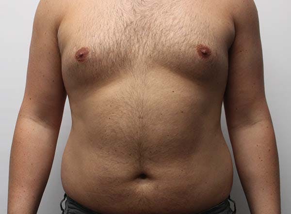 Liposuction For Men Before & After Gallery - Patient 122160739 - Image 3