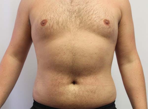 Liposuction For Men Before & After Gallery - Patient 122160739 - Image 4
