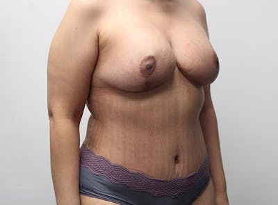 Mommy Makeover Before & After Gallery - Patient 122106829 - Image 4