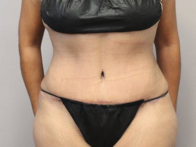 Tummy Tuck Before & After Gallery - Patient 122597407 - Image 2