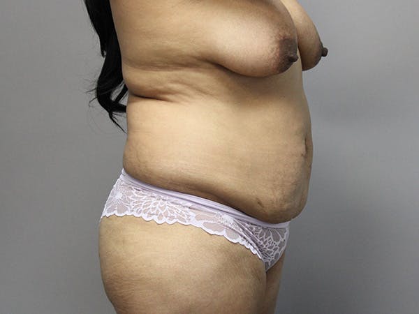 Tummy Tuck Before & After Gallery - Patient 122597407 - Image 3