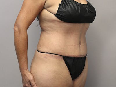 Tummy Tuck Before & After Gallery - Patient 122597407 - Image 4