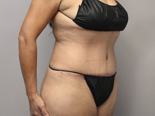 Tummy Tuck Before & After Gallery - Patient 122597407 - Image 4