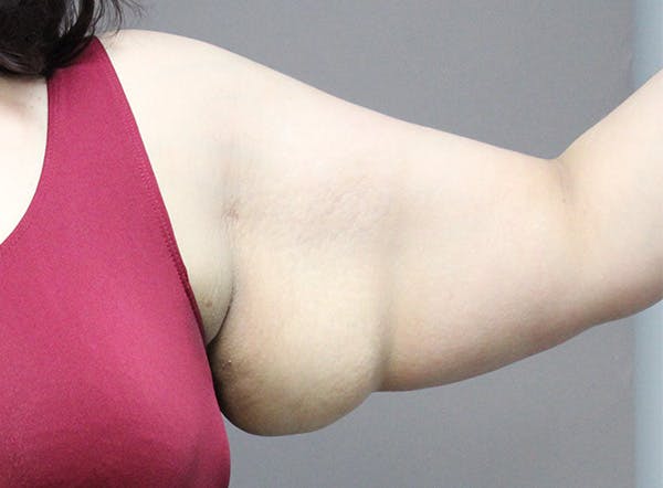 Arm Lift Before & After Gallery - Patient 123044504 - Image 3