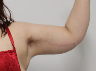 Arm Lift Before & After Gallery - Patient 123044504 - Image 4