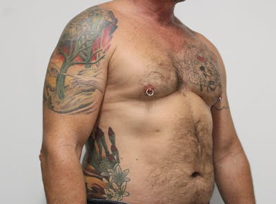 Liposuction For Men Before & After Gallery - Patient 140840268 - Image 1