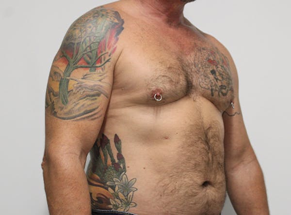 Liposuction For Men Before & After Gallery - Patient 140840268 - Image 1