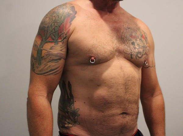 Liposuction For Men Before & After Gallery - Patient 140840268 - Image 2