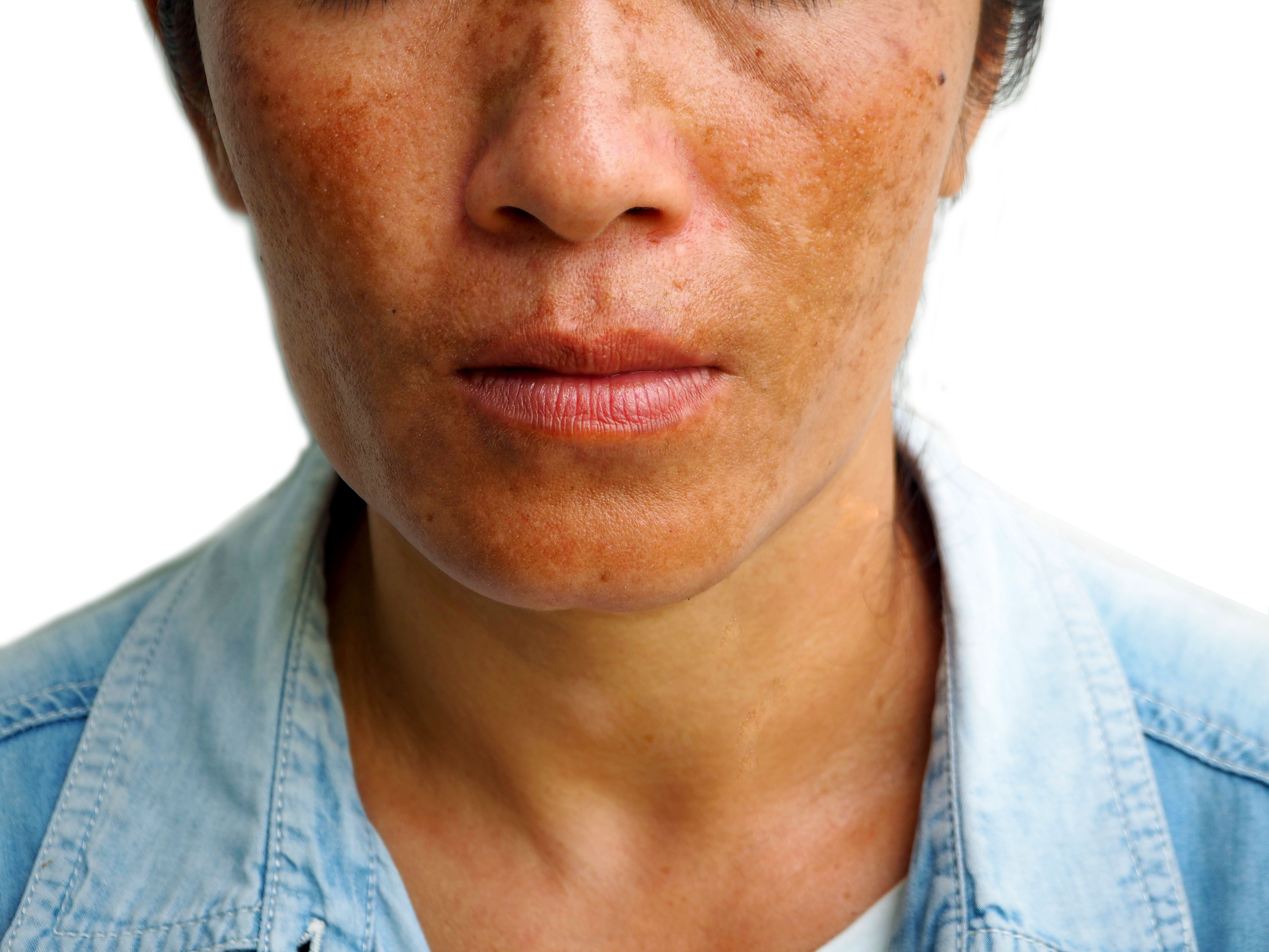 woman with melasma