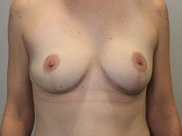 Breast Lift Before & After Gallery - Patient 141201092 - Image 2