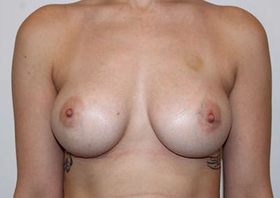 Breast Augmentation Before & After Gallery - Patient 143744000 - Image 2