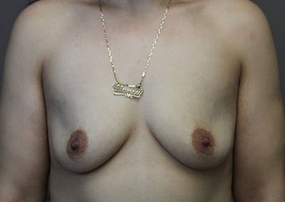 Breast Augmentation Before & After Gallery - Patient 143744001 - Image 1