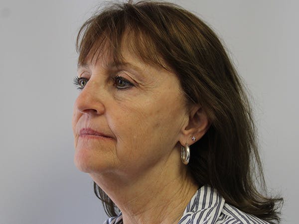 Facelift Before & After Gallery - Patient 146150528 - Image 3