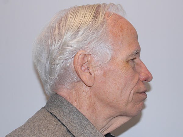 Facial Rejuvenation Before & After Gallery - Patient 350346 - Image 3