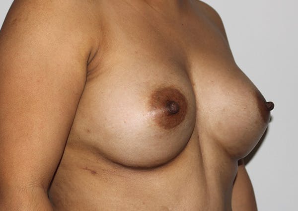 Breast Augmentation Before & After Gallery - Patient 147437717 - Image 4