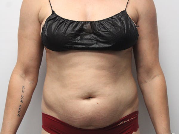 Liposuction Before & After Gallery - Patient 148128759 - Image 1