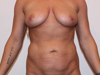 Liposuction Before & After Gallery - Patient 148128759 - Image 2