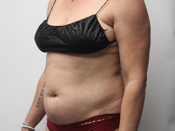 Liposuction Before & After Gallery - Patient 148128759 - Image 3