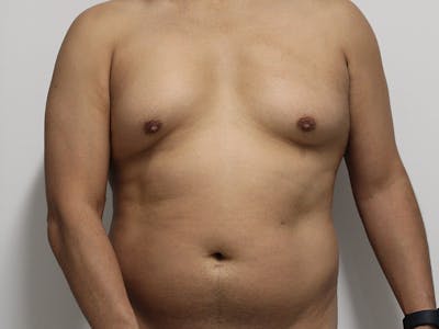 Liposuction For Men Before & After Gallery - Patient 148128762 - Image 1