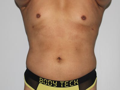 Liposuction For Men Before & After Gallery - Patient 148128762 - Image 2