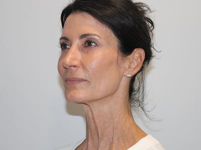 Skin Resurfacing Before & After Gallery - Patient 148128764 - Image 4