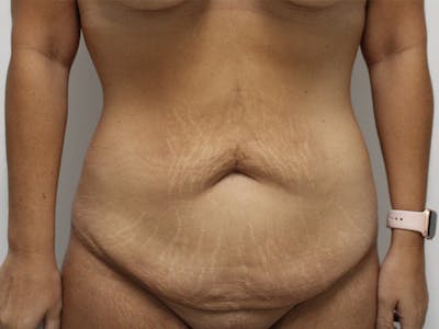 Tummy Tuck Before & After Gallery - Patient 148128765 - Image 1