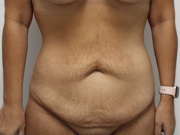Tummy Tuck Before & After Gallery - Patient 148128765 - Image 1
