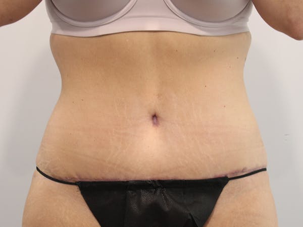 Tummy Tuck Before & After Gallery - Patient 148128765 - Image 2