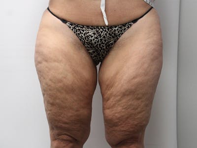 Thigh Lift Before & After Gallery - Patient 148128767 - Image 1