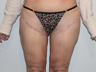 Thigh Lift Before & After Gallery - Patient 148128767 - Image 2