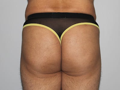 Brazilian Butt Lift for Men  Before & After Gallery - Patient 148128770 - Image 2
