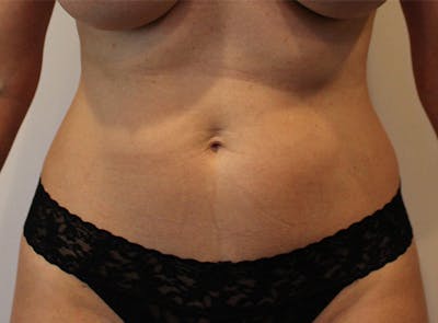 Liposuction Before & After Gallery - Patient 149192489 - Image 1