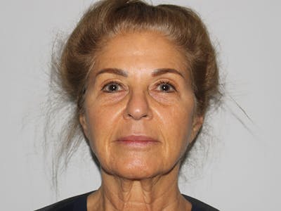 Facelift Before & After Gallery - Patient 149236324 - Image 1