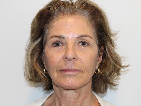Facelift Before & After Gallery - Patient 149236324 - Image 2