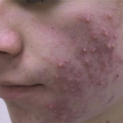 Acne Before & After Gallery - Patient 173546975 - Image 1