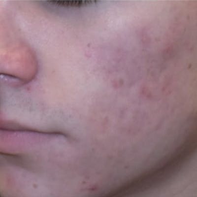 Acne Before & After Gallery - Patient 173546975 - Image 2