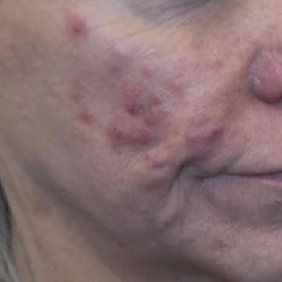 Acne Before & After Gallery - Patient 173546976 - Image 1