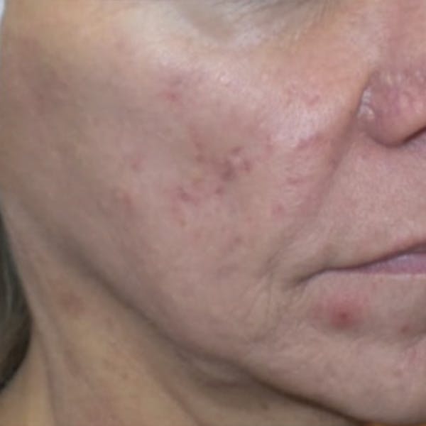 Acne Before & After Gallery - Patient 173546976 - Image 2