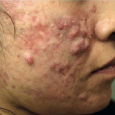 Acne Before & After Gallery - Patient 173546977 - Image 1